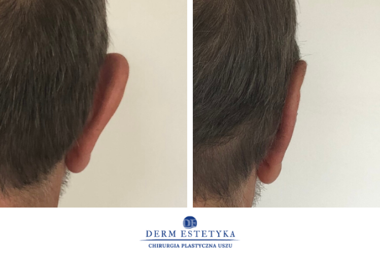 Operacja plastyczna uszu - przed i po 